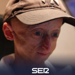 Hallado en España un tratamiento contra la progeria, la enfermedad que convierte a niños en ancianos