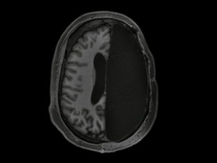 Medio cerebro basta: así se reorganizan las conexiones cuando solo queda un hemisferio