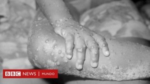 La viruela, la única enfermedad humana que ha sido erradicada y qué lecciones dejó para enfrentar la pandemia de covid19