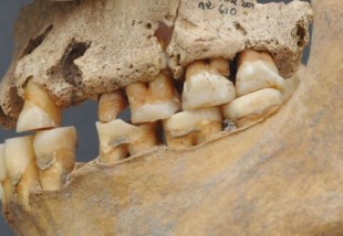 Enfermedad y muerte en la Prehistoria