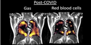 Esto es lo que provoca la Covid-19 en los pulmones: daño casi irreversible
