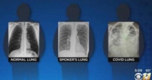 Los pulmones post-COVID son peores que los pulmones de los peores fumadores, dice un cirujano [ING]