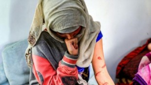 Una joven de 19 años, desfigurada por el ácido, pone rostro al maltrato de la mujer en Yemen 