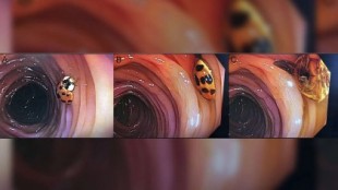 Una colonoscopia a un hombre de 59 años descubre una mariquita en su intestino