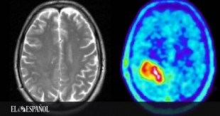 Golpe español al tumor cerebral más letal: descubren el 'eslabón perdido' del glioblastoma