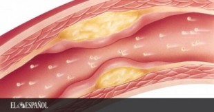 Ésta es la nueva técnica que puede reducir el colesterol con una dosis cada 6 meses