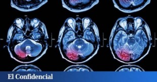 Una nueva terapia elimina tumores cerebrales en pacientes terminales