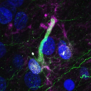 Las enfermedades neurodegenerativas atacan a las células madre del cerebro e impiden generar nuevas neuronas