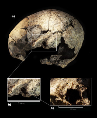 La Universidad de Valladolid documenta la primera cirugía otológica exitosa de la historia en el dolmen ‘El Pendón’