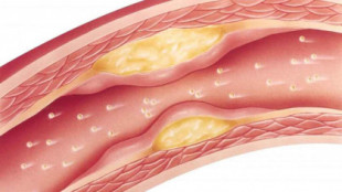 Golpe español al colesterol: ésta es la nueva técnica que consigue 'limpiar' las arterias