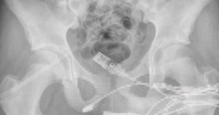 Un adolescente es operado de urgencia tras introducirse un cable USB en la uretra para saber su tamaño