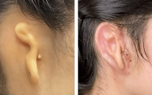 Una mujer recibe el primer trasplante exitoso de una oreja viva impresa en 3D [EN]