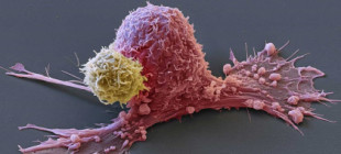 Una vacuna de ARN logra un primer éxito contra el cáncer de páncreas, el tumor más letal