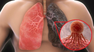 Éxito español en cáncer de pulmón: un nuevo tratamiento eleva un 20% la supervivencia