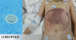 Herido un menor en Córdoba al ser succionado por la depuradora de una piscina