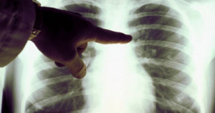 España necesita un cribado de cáncer de pulmón"