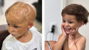 El peluquero que les devuelve la autoestima a los niños que perdieron el pelo en accidentes