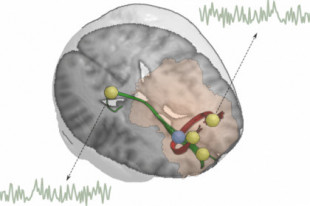 Frenar el deterioro de la sustancia blanca del cerebro puede reducir la recaída en pacientes que consumen alcohol