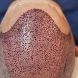 La vacuna que promete curar la alopecia pone en alerta a la industria del trasplante capilar