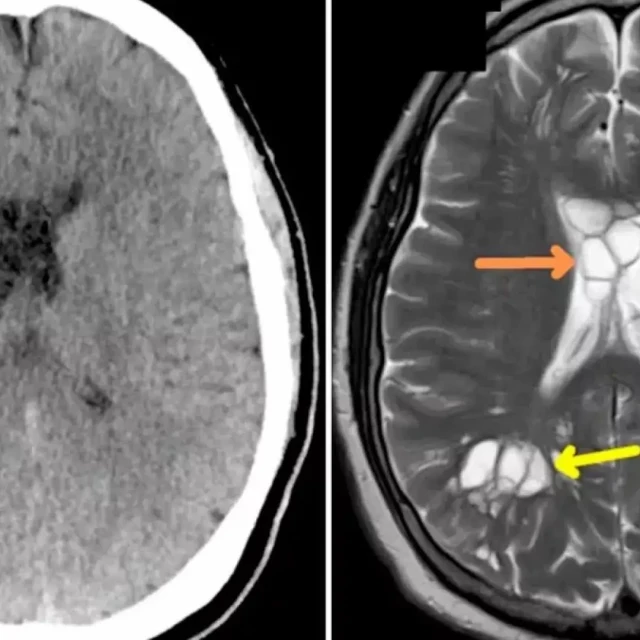 Un hombre con constantes migrañas descubre que tenía un parásito en el cerebro tras comer bacon poco hecho