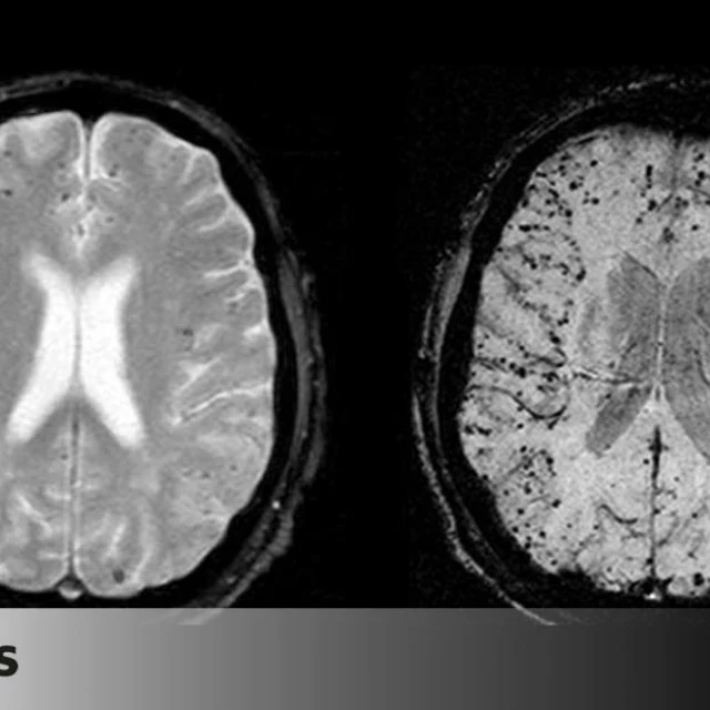 Identifican los primeros posibles casos de transmisión de una enfermedad cerebral en España