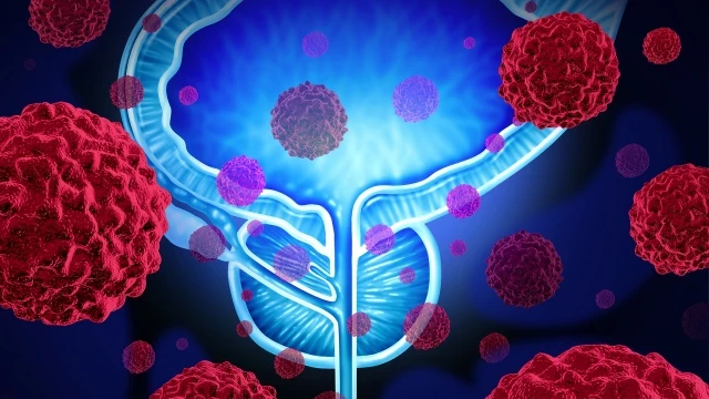 Un análisis de orina suficiente para detectar cáncer de próstata