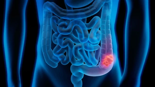 Un medicamento capaz de "derretir" tumores podría reemplazar a la cirugía para el cáncer de colon
