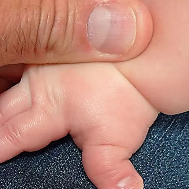 ¿Qué es el Síndrome de Rubinstein Taybi, también llamado enfermedad de los dedos gordos?