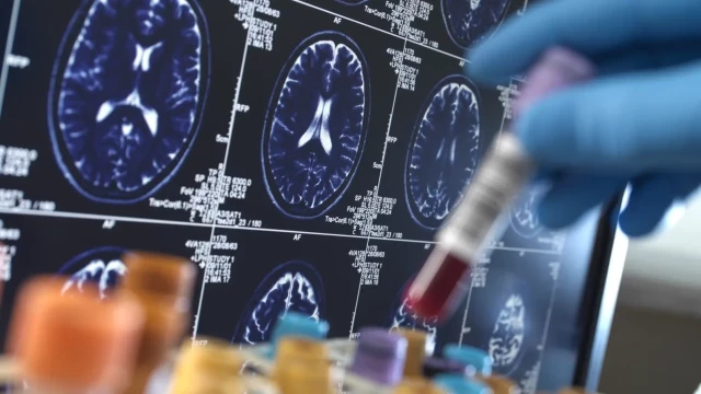 Investigadores generan neuronas a partir de células de la piel para estudiar el alzhéimer