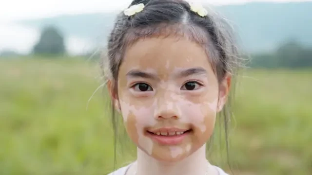 Vitiligo, la enfermedad de la piel que a pesar de ser común es muy poco conocida