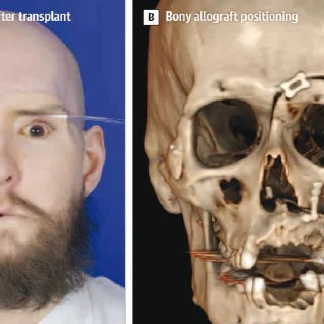 Un año después, el ojo nuevo del primer receptor en el mundo de un trasplante completo de rostro y ojo muestra alguna respuesta a la luz (ENG)