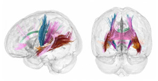 Primer mapa completo de la ‘metamorfosis’ cerebral del embarazo