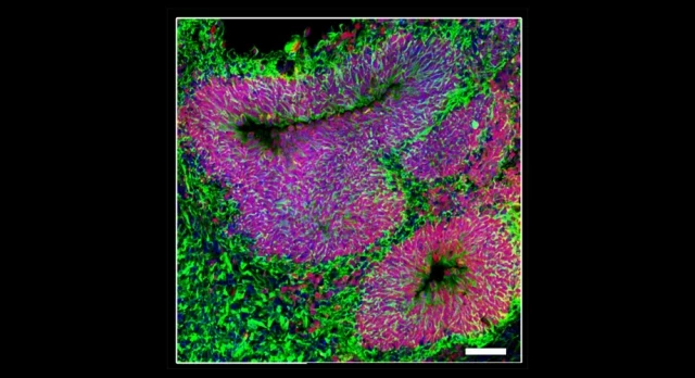 Los “minicerebros humanos” ( organoides ) revelan la biología del autismo y sus posibles tratamientos (eng)